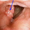 喉頭ガン